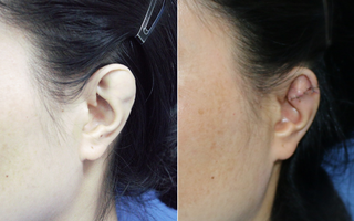 Phẫu thuật cho người phụ nữ 34 tuổi có vành tai khác thường