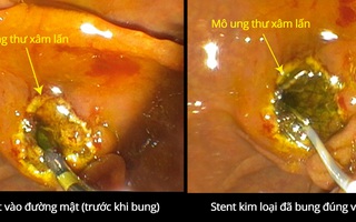 Phút giây giải tắc mật cho ca bệnh đã hôn mê