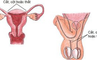 Vợ hay chồng đi triệt sản thì "nhẹ nhàng" hơn?