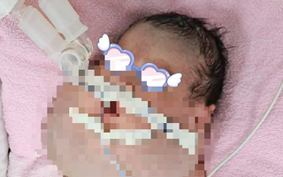 TP HCM: Bé trai mới sinh có khuôn mặt to khó tưởng