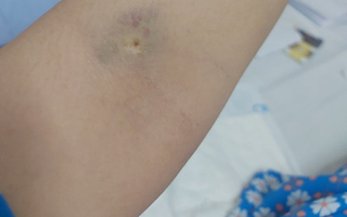 TP HCM: Sản phụ liệt nửa người sau sinh mổ tại Bệnh viện Phụ sản Mêkông