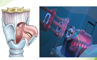 Không bị tái phát khi điều trị ung thư thanh quản bằng laser vi phẫu