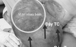 Cứu sống sản phụ mang thai ở góc tử cung hiếm gặp