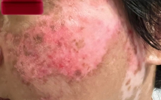 Dùng đơn thuốc cũ chữa lupus ban đỏ, nữ bệnh nhân trẻ phải lọc máu cấp cứu