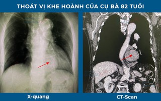 Kịp cứu ca bệnh 10 năm uống thuốc nhầm