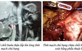 Robot cắt thận và lấy chồi bướu ca bệnh đầu tiên Việt Nam