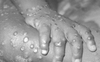 Vắc-xin đậu mùa khỉ: WHO chưa khuyến cáo tiêm chủng đại trà