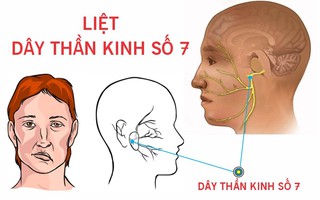 Làm sao chữa di chứng liệt dây thần kinh số 7 sau khi bị zona?