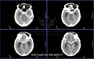 Ca bệnh 90% tử vong, bác sĩ nói "còn nước còn tát"