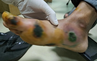 Bệnh nhân đái tháo đường loét bàn chân do thói quen thường gặp