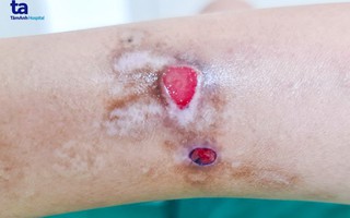 Kỳ lạ: Người phụ nữ ở TP HCM tự cào rách da mỗi lần căng thẳng