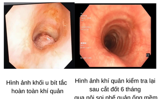 Bệnh hay gặp ở màng nhầy đường sinh dục nhưng lại xuất hiện ở khí quản cô gái 17 tuổi