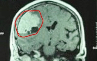 Đau đầu nhiều năm, đi khám mới phát hiện khối u màng não