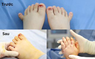Hiếm gặp: Bé gái ở Quảng Nam có 12 ngón tay, 12 ngón chân