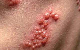 Nhiễm virus Herpes sau khi xăm làm đẹp