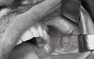 Người phụ nữ gặp nạn sau 5 năm phẫu thuật tạo má lúm đồng tiền