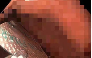 Nuốt nhầm thuốc còn nguyên vỏ, người đàn ông nhập viện cấp cứu