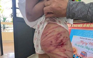 Xác minh thông tin bé gái nghi bị cha dượng bạo hành