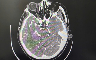 Đột quỵ khi uống bia, người đàn ông thoát chết ngoạn mục