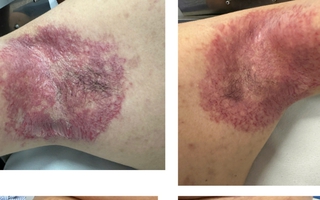 Bất ngờ từ ca bệnh da di truyền hiếm gặp đáp ứng botulinum toxin