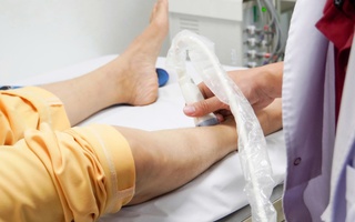 Làm sao biết bị suy giãn tĩnh mạch, chữa trị thế nào?