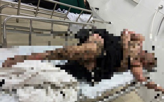 Bị bỏng toàn thân khi quăng câu vướng vào dây điện