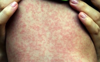 Dịch sởi bùng phát tại một xã