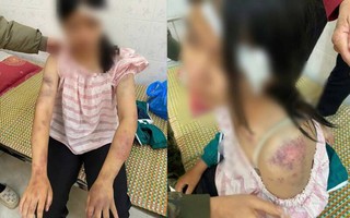 Bé gái 13 tuổi bị bà nội tra khảo, đánh đập dã man, người chi chít vết thương