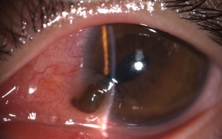 Khẩn cứu người đàn ông bị đinh bắn vào mắt