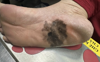 Đốm đen trên da có phải là dấu hiệu ung thư da?