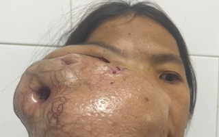 Người phụ nữ mang khối u khổng lồ trên mặt suốt nhiều năm