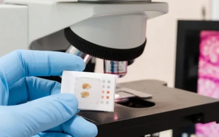 Thêm tiềm năng của AI trong cải thiện điều trị ung thư