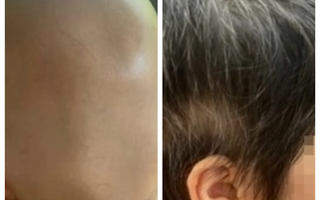 Bé gái 7 tuổi rụng tóc toàn đầu, hồi phục kỳ diệu sau một năm