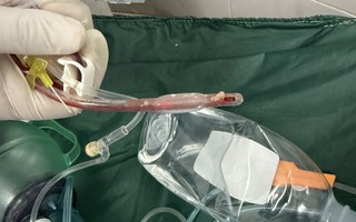 Bác sĩ cấp cứu đau lòng trước bé gái 3 tuổi sặc thức ăn ở nhà trẻ