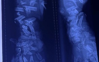 Tai nạn lao động thương tâm: Công nhân 37 tuổi bị máy nghiền vỏ dừa cán nát cánh tay