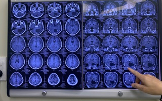 150 phút nghẹt thở với người đàn ông vào bệnh viện trong tình trạng đau đầu dữ dội