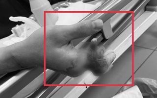Cuộc mổ xuyên đêm cứu 4 ngón tay dập nát, gần đứt rời