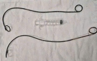 Bệnh nhân ở Cà Mau "bỏ quên" ống thông JJ trong người suốt hơn 10 năm