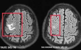 Co giật do sán não suýt nhầm lẫn với u não
