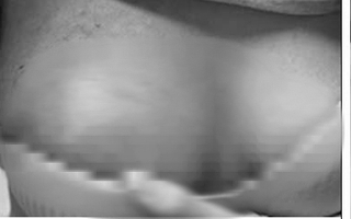 Hoại tử ngực vì tiêm chất làm đầy