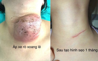 Phẫu thuật nội soi đóng rò xoang lê cho hàng chục trẻ em