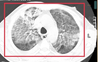 Nam lao động từ Thái Lan về nước nguy kịch vì Whitmore