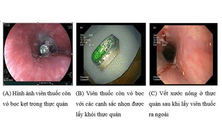 Nhiều người nhập viện vì uống thuốc còn nguyên vỏ