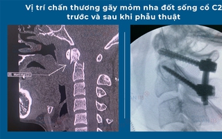 Phẫu thuật kịp thời, cứu sống thanh niên bị tai nạn giao thông nguy kịch