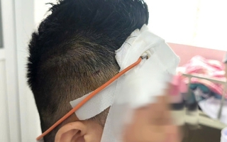 Ngã xe máy, một tháng sau mới lộ chấn thương sọ não