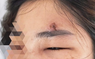 Nặn mụn trứng cá, nữ bệnh nhân nhập viện nguy kịch