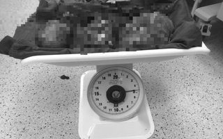 Bệnh viện Vũng Tàu tách khối u nặng 5 kg khỏi bụng người phụ nữ 56 tuổi
