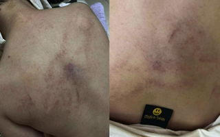 Tạm đình chỉ công tác 2 giáo viên nghi bạo hành trẻ