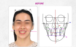 Cân chỉnh đường giữa và chữa lệch mặt bằng phương pháp niềng răng