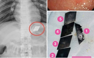 Hãi hùng một bệnh nhân "ngáo đá" ở TP HCM nuốt trọn bộ dao 5 món vào bụng